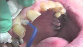 Mini Dental Implant for Replacement of Missing Tooth Maxillary Lateral Incisor [upl. by Verda]