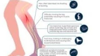 common peroneal nerve disorder and its physiotherapy treatment [upl. by Paquito]