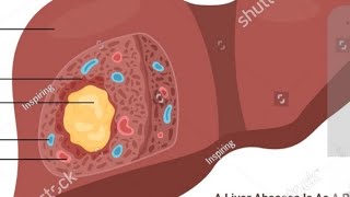 Medicine part Liver Abscess by sasi sir 20810517 [upl. by Giuliana]