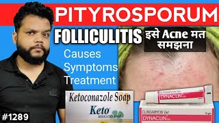 Fungal Acne का कारण और इलाज  Pityrosporum Folliculitis CauseSymptoms amp Treatment In Hindi [upl. by Busey]