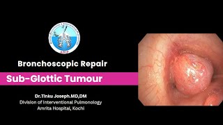 Subglottic Airway Tumour  Bronchoscopic management [upl. by Yerak]