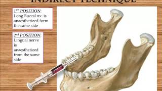 Inferior Alveolar Nerve Block [upl. by Nnaeirual980]