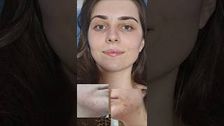 Surto de acne  tratamento com Tetralysal funciona Vem descobrir comigo [upl. by Lisk]