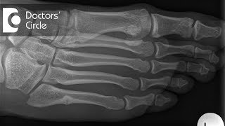 What should one do to speed up the recovery post surgery for Metatarsal Fracture  Dr Mohan M R [upl. by Magee]