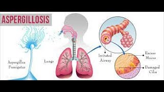 Aspergillosis  causes symptoms treatment  aspergillus fungal lung infection  aspergilloma [upl. by Tiga]