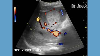 Multifocal hepatoma or hepatocellular carcinoma liver masses ultrasound and color Doppler video [upl. by Anaujik]