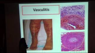 Calciphylaxis Dr Mona Tawfik MNDU 2016 [upl. by Mickelson]