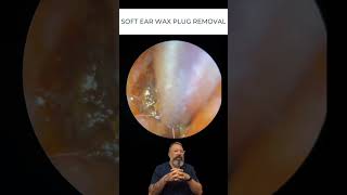 SOFT EAR WAX PLUG REMOVAL [upl. by Madel343]