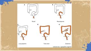 Lecture 4  Hirschsprung disease  Surgical Module SMPediatrics [upl. by Gareth]