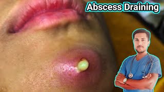 Abscess Treatment Causes Symptoms and Removalquot [upl. by Eemak193]