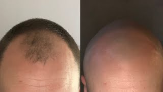 Thinning Hairline In A 4 Week Timelapse [upl. by Cheatham]