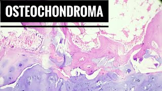 Osteochondroma Histopathology [upl. by Tavis]