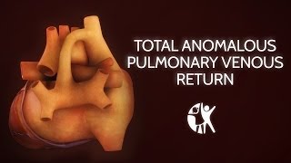 Total Anomalous Pulmonary Venous Return [upl. by Nareht918]