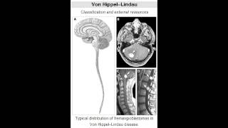 von Hippel Lindau Disease [upl. by Steel]