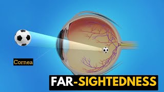 Farsightedness Causes Signs and Symptoms Diagnosis and Treatment [upl. by Grimbald]