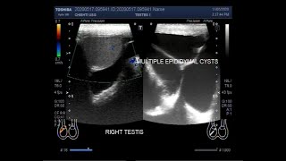 A Large multiseptic Epididymal cyst [upl. by Nova403]