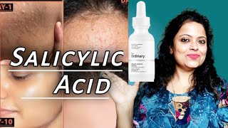 Best for Ance Pimples Bumps  SALICYLIC ACID  The Ordinary Salicylic Acid Serum review Saanch [upl. by Doralia]