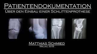 Patientendokumentation über den Einbau einer Schlittenprothese im Knie [upl. by Nesiaj157]