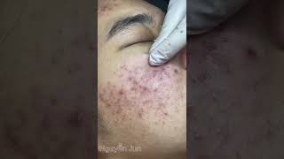 Acne skin care and treatment restore damaged skinđiềutrịmụn [upl. by Froemming]