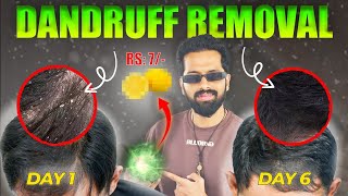 Click Here 5 DANDRUFF Home Remedies Fully natural hair mentransformation [upl. by Hogle]