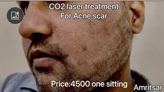 I got franctional CO2 Laser Treatment for Acne Scars  first sitting  Before After Results [upl. by Delainey]