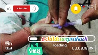 Cannulation technique Newborn baby cannula nicu injection [upl. by Ehsom]