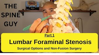 Lumbar Foraminal Stenosis  Surgical Options and NonFusion Surgery [upl. by Mozelle]