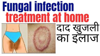 Fungal infection treatment at home  Khujli ki medicine  Daad ki best medicine [upl. by Vergne]