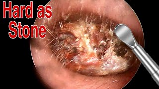 BIGGEST Ear Wax Difficult Removal  EP2  Doctor Anh [upl. by Dallas98]