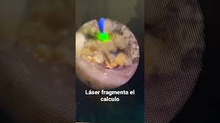 LASER para piedras del riñón  urotips [upl. by Beard988]