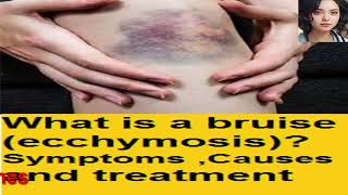 What is a bruise ecchymosis Symptoms  Causes and treatment [upl. by Sucitivel]