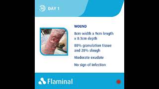 Case Report  Venous Leg Ulcer with Flaminal® Forte [upl. by Esyli]