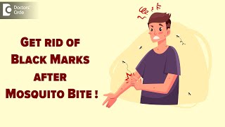 MOSQUITO BITE MARKS  How to treat black marks after mosquito biteDr Nischal K  Doctors Circle [upl. by Icyak]