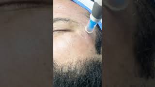 Dermapen Microneedling for acne scars  Dermalyn Aesthetics  Dr Muskan Tyagi [upl. by Braeunig207]