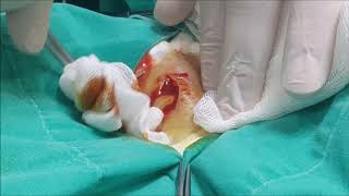 Apse Kasıkta  Abscess İnguinal region [upl. by Ranee145]