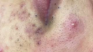 Big blackheads whiteheads pimple popping  Nhat Bang Acne Treatment  Chuyen Nguyen Spa 14 [upl. by Eecats]