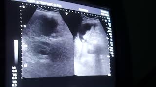 chronic liver disease with splenomagly and gross ascites Ultrasound liver for hepatitis C [upl. by Linell]