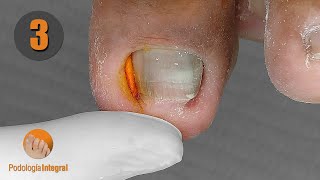 1 year later  Ingrown toenail amp granuloma 3rd part podologiaintegral [upl. by Niasuh]