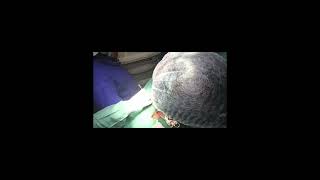 Sistrunk Surgery for Thyroglossal cyst [upl. by Dodd]