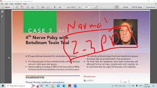 lecture three 4 th nerve Palsy with Botulinum toxin trial [upl. by Yoko]