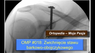 Zwichnięcie stawu barkowoobojczykowego  OMP018 [upl. by Mhoj]