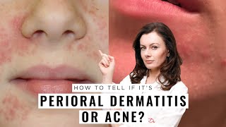 Perioral Dermatitis or Acne How to Tell the Difference  Dr Sam Bunting [upl. by Cochran]