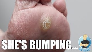 SUPER THICK HARD SKIN BUMP REMOVAL [upl. by Pega]