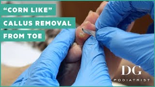 quotCorn likequot callus removal from toe [upl. by Adnuhsal]