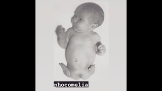 Phocomelia  A limb abnormality and a type of Meromelia [upl. by Nosyk]