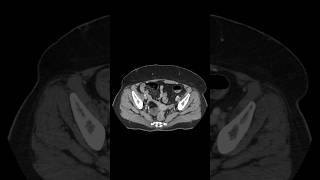 cect pelvis Ovarian teratoma shortsfeed [upl. by Marlena]