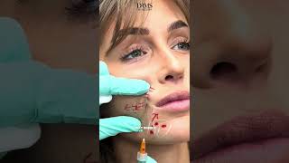 Expert Guide to Smooth Smile Lines Skin Booster Injections [upl. by Stormi998]