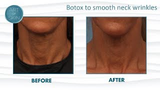 Botox To Lift Neck And Smooth Wrinkles [upl. by Huberman]