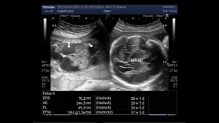 Fetal ascites Fetal hydronephrosis Pericardial effusion and dilated brain ventricles [upl. by Sorgalim]