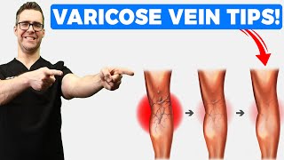 Best Varicose Vein Home Treatments Top 25 Spider Veins Remedies [upl. by Lemal]